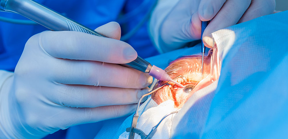 Testimonianze Impianto Di Lenti Intraoculari - Micro Chirurgia Oculare - Foto 11